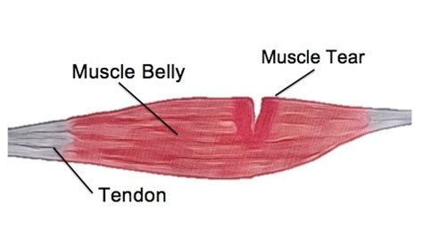 what test will show a muscle tear|muscle tears away from bone.